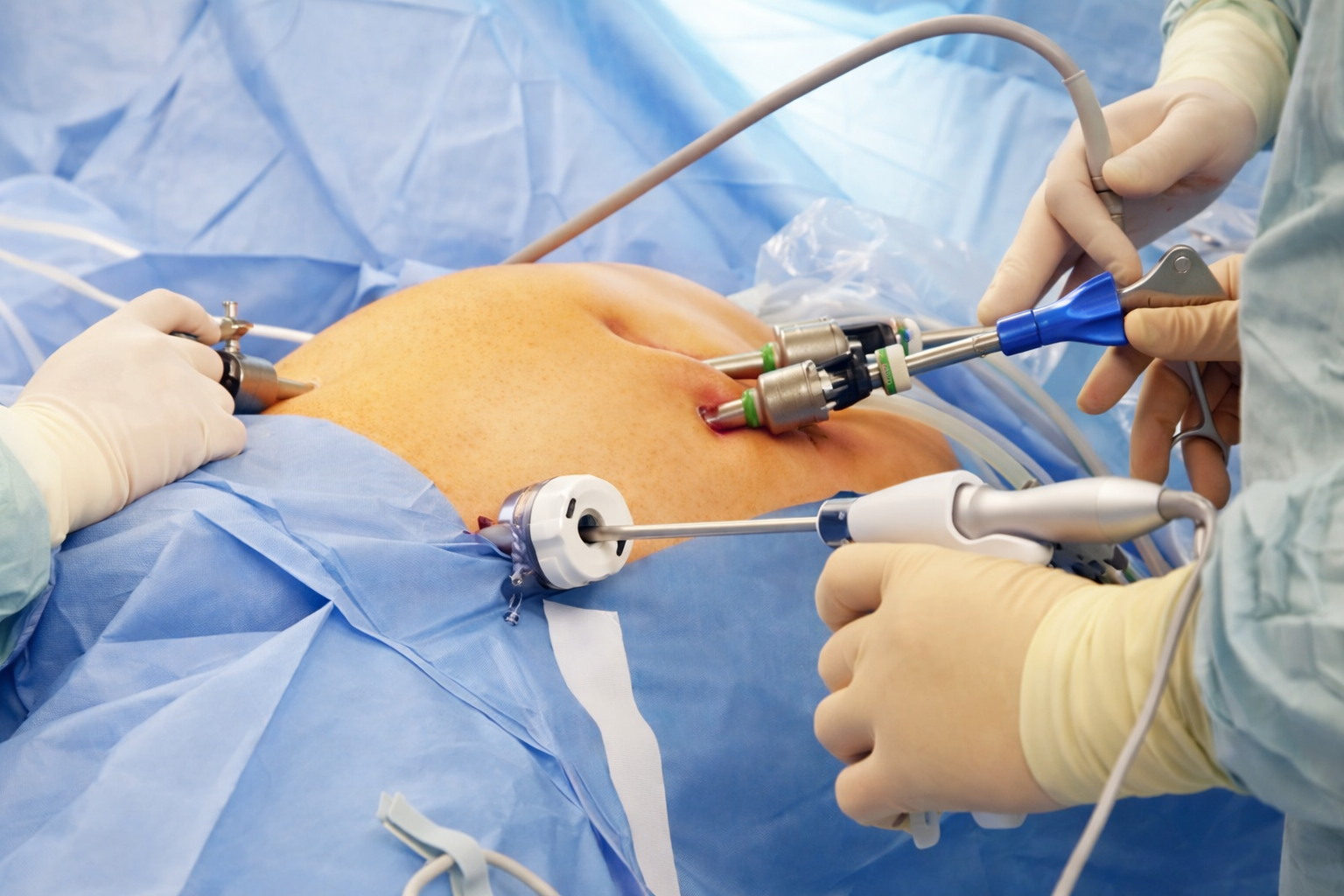 Advanced Laparoscopy